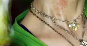 Alergia al oro images